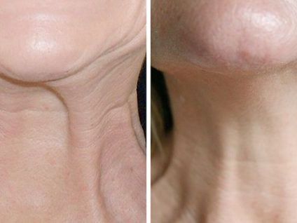 neck-lift-with-suture-suspension-ealing-call-02036330332