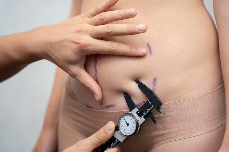 abdomen-suture-suspension-lift-chiswick-call-02036330332-big-0