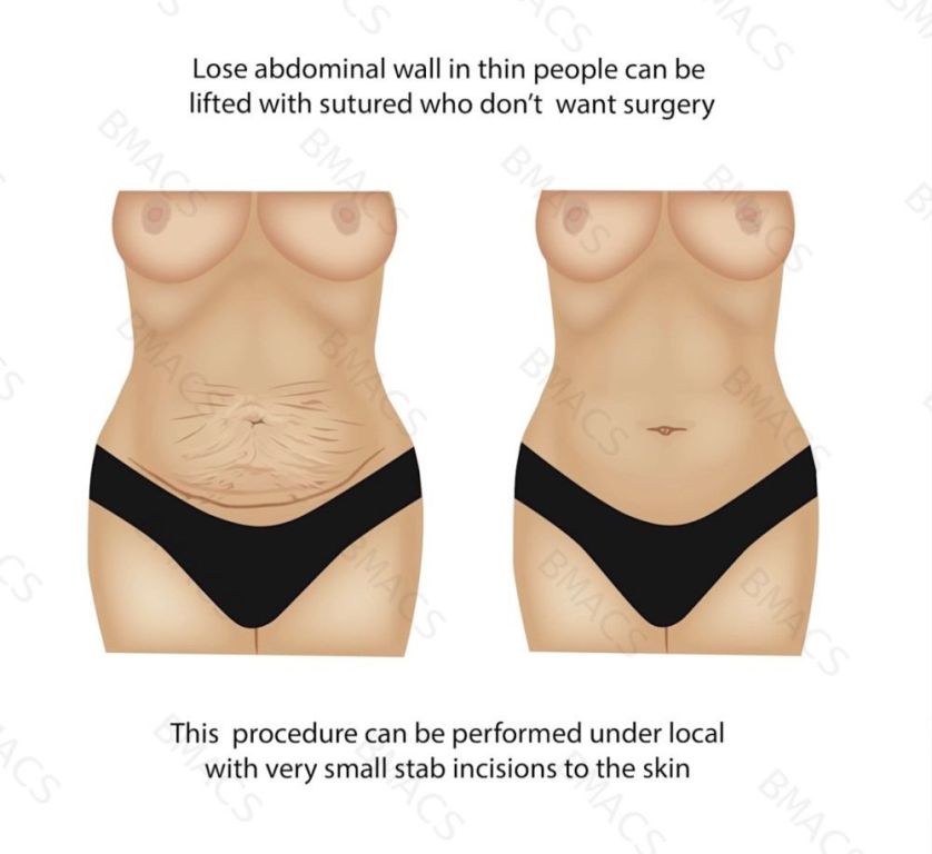 abdomen-suture-suspension-lift-chiswick-call-02036330332-big-1
