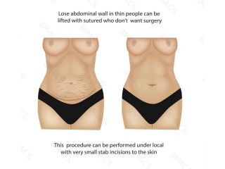 abdomen-suture-suspension-lift-chiswick-call-02036330332-small-1