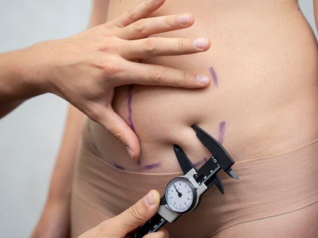 abdomen-suture-suspension-lift-chiswick-call-02036330332