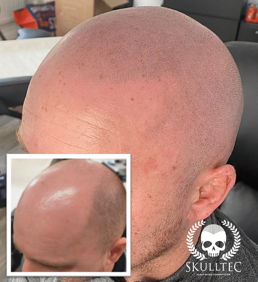 expert-scalp-micropigmentation-in-glasgow-skulltec-big-0