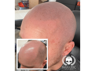 expert-scalp-micropigmentation-in-glasgow-skulltec-small-0