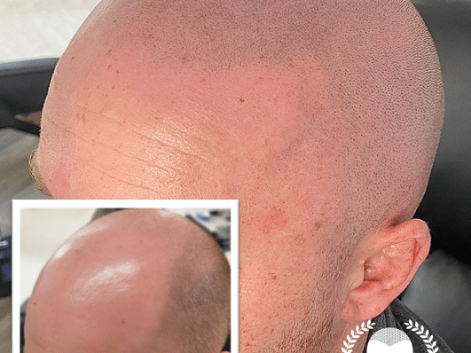 expert-scalp-micropigmentation-in-glasgow-skulltec