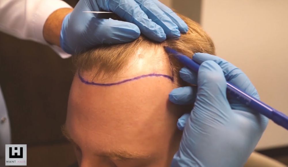 best-hair-transplant-turkey-affordable-natural-results-big-0