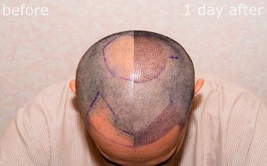 best-hair-transplant-turkey-affordable-natural-results-big-1