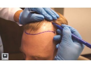 best-hair-transplant-turkey-affordable-natural-results-small-0