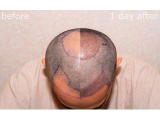 best-hair-transplant-turkey-affordable-natural-results-small-1