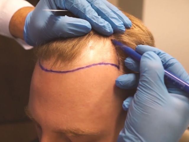 best-hair-transplant-turkey-affordable-natural-results