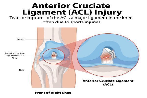 acl-injury-treatment-by-specialist-knee-surgeon-big-0