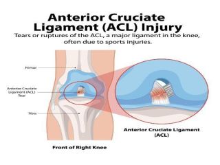 acl-injury-treatment-by-specialist-knee-surgeon-small-0