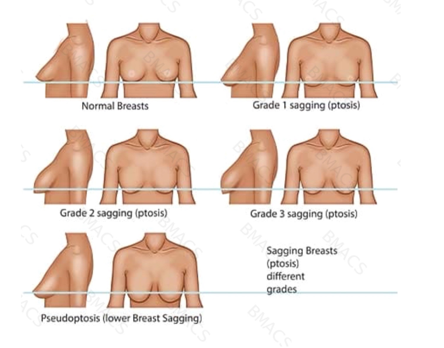 breast-lift-with-suture-suspension-ealing-big-0