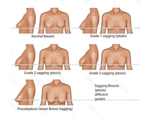 breast-lift-with-suture-suspension-ealing-small-0