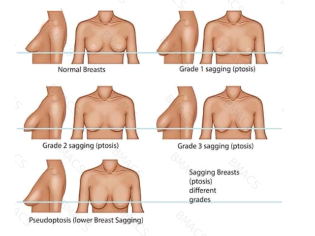 breast-lift-with-suture-suspension-ealing
