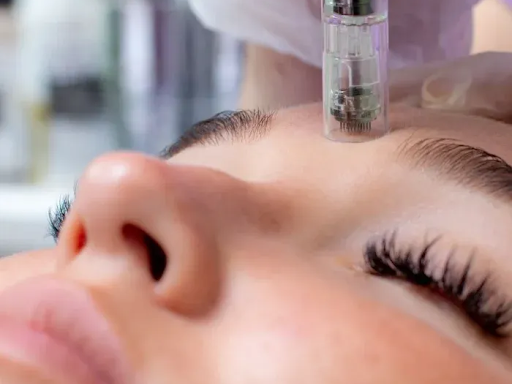 best-microneedling-near-kentish-town-ldn-clinic