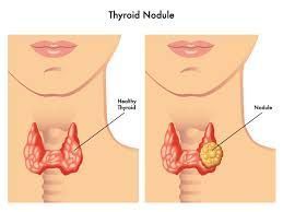 safe-thyroid-nodule-treatmente-for-fast-recovery-big-0