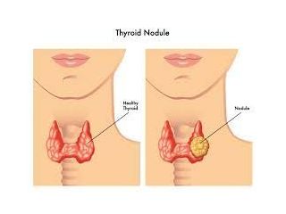 safe-thyroid-nodule-treatmente-for-fast-recovery-small-0