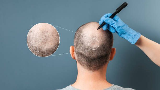 want-hair-ltd-trusted-fue-hair-transplant-clinic-in-manchester-big-0
