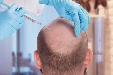 want-hair-ltd-trusted-fue-hair-transplant-clinic-in-manchester-big-1