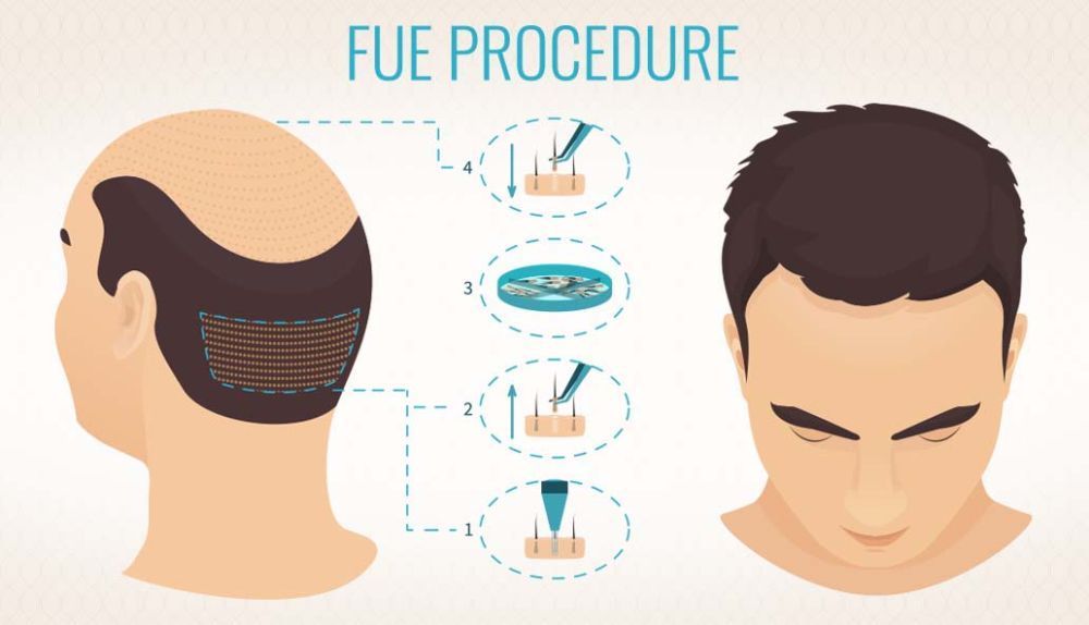 want-hair-ltd-trusted-fue-hair-transplant-clinic-in-manchester-big-2