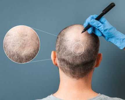 want-hair-ltd-trusted-fue-hair-transplant-clinic-in-manchester
