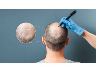 want-hair-ltd-trusted-fue-hair-transplant-clinic-in-manchester-small-0