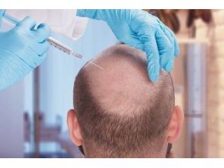 want-hair-ltd-trusted-fue-hair-transplant-clinic-in-manchester-small-1