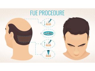 want-hair-ltd-trusted-fue-hair-transplant-clinic-in-manchester-small-2