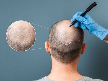 want-hair-ltd-trusted-fue-hair-transplant-clinic-in-manchester