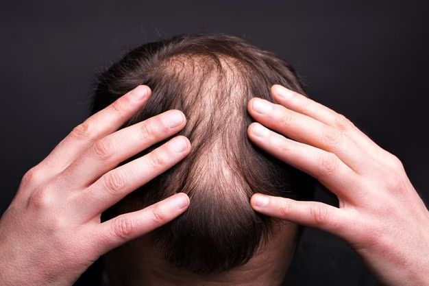 say-goodbye-to-hair-loss-try-alopecia-treatment-uk-big-1