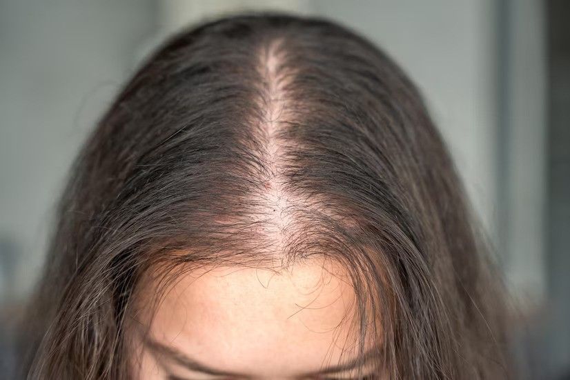 say-goodbye-to-hair-loss-try-alopecia-treatment-uk-big-2