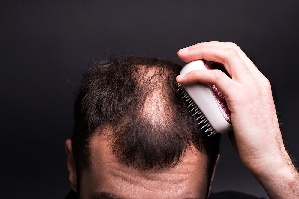 say-goodbye-to-hair-loss-try-alopecia-treatment-uk-big-3