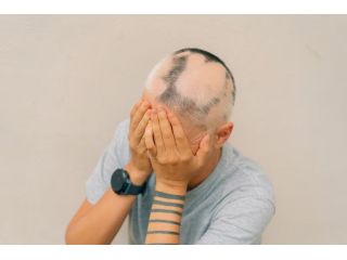 say-goodbye-to-hair-loss-try-alopecia-treatment-uk-small-0