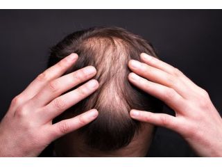 say-goodbye-to-hair-loss-try-alopecia-treatment-uk-small-1