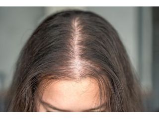 say-goodbye-to-hair-loss-try-alopecia-treatment-uk-small-2
