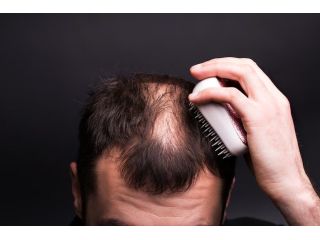 say-goodbye-to-hair-loss-try-alopecia-treatment-uk-small-3