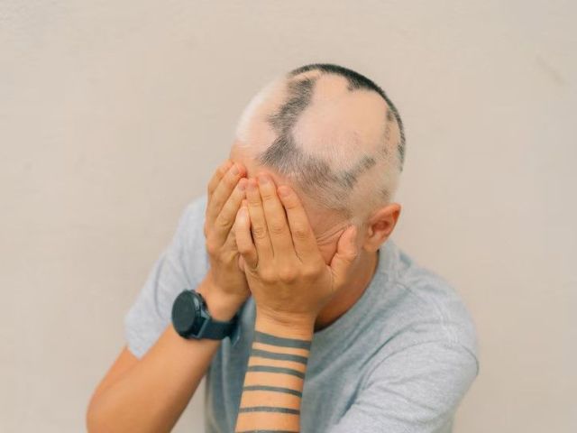 say-goodbye-to-hair-loss-try-alopecia-treatment-uk