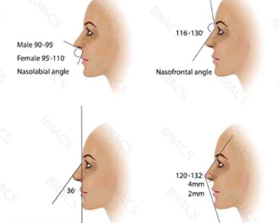 dermal-filler-nose-job-in-chiswick-no-surgery-no-downtime