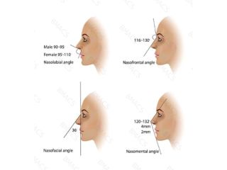 dermal-filler-nose-job-in-chiswick-no-surgery-no-downtime-small-0