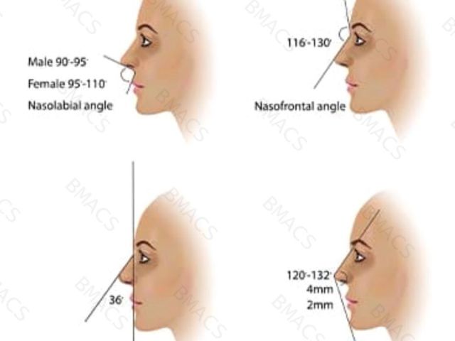 dermal-filler-nose-job-in-chiswick-no-surgery-no-downtime