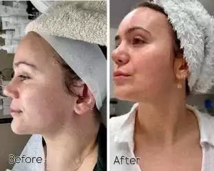 advanced-skin-care-laser-treatments-in-maidenhead
