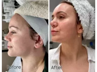 advanced-skin-care-laser-treatments-in-maidenhead-small-0