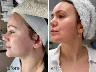 advanced-skin-care-laser-treatments-in-maidenhead