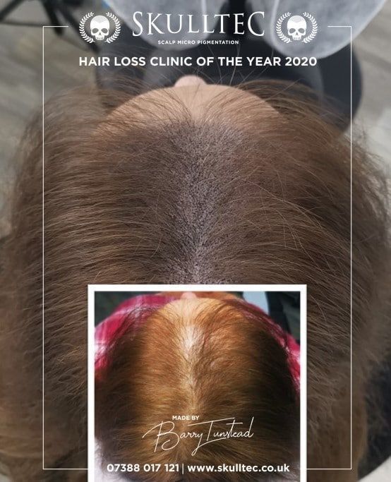 scalp-micropigmentation-for-women-big-0