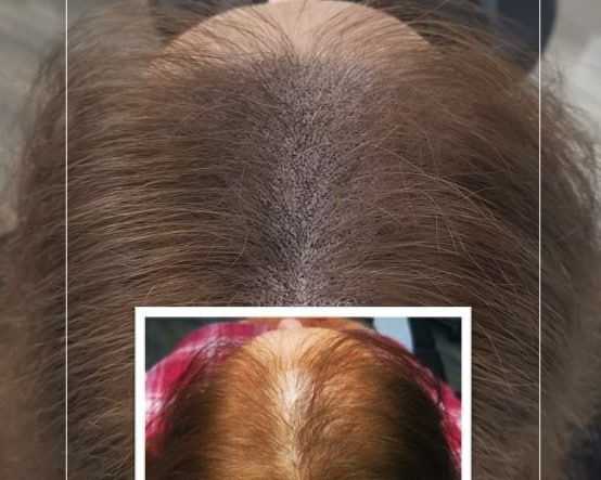 scalp-micropigmentation-for-women