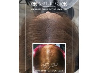 scalp-micropigmentation-for-women-small-0