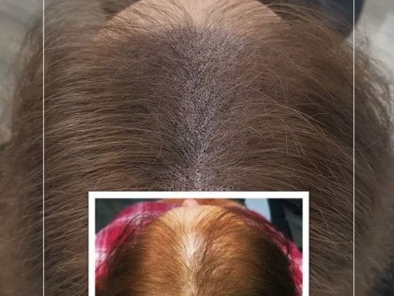 scalp-micropigmentation-for-women