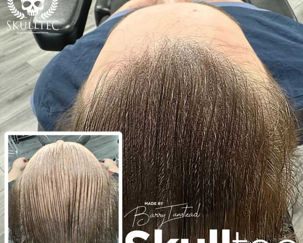 scalp-micropigmentation-for-long-hair-skulltec