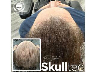 scalp-micropigmentation-for-long-hair-skulltec-small-0