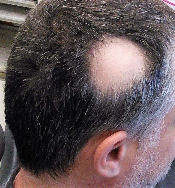 effective-scalp-micropigmentation-for-alopecia-skulltec-big-0